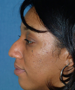 Nose Reshaping Before