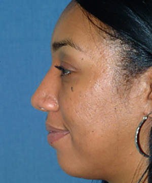 Nose Reshaping After