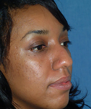 Nose Reshaping Before