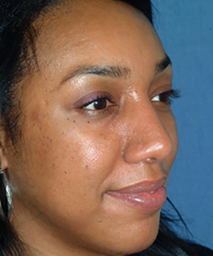 Nose Reshaping After