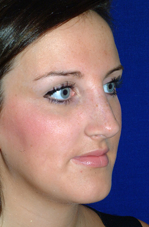 Nose Reshaping After