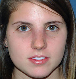 Nose Reshaping After