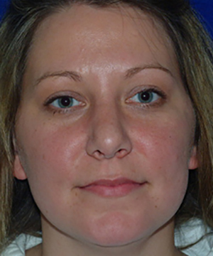 Nose Reshaping After