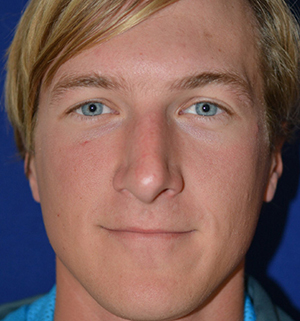 Nose Reshaping After