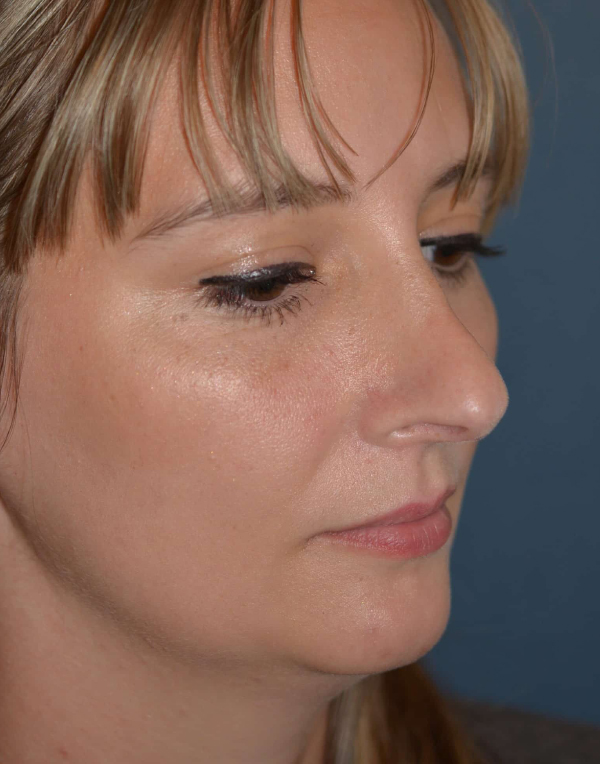 Nose Reshaping Before
