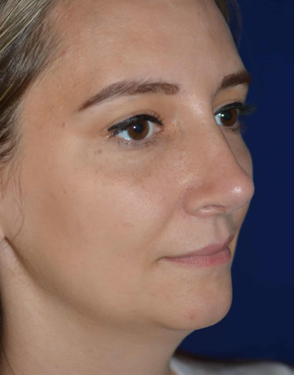 Nose Reshaping After