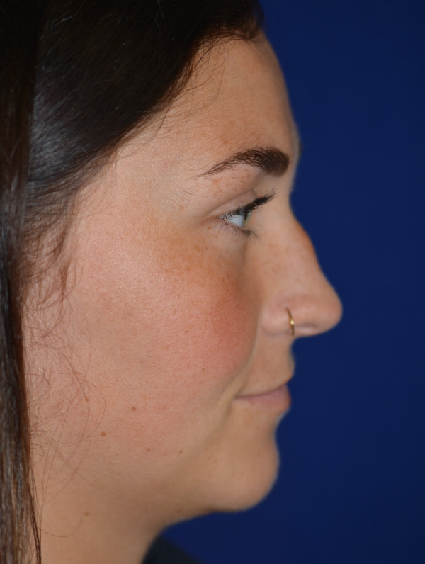 Nose Reshaping Before