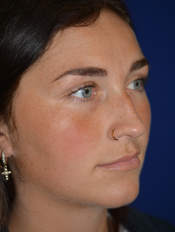 Nose Reshaping Before