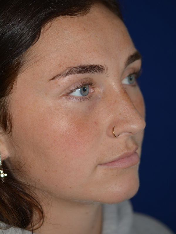 Nose Reshaping After