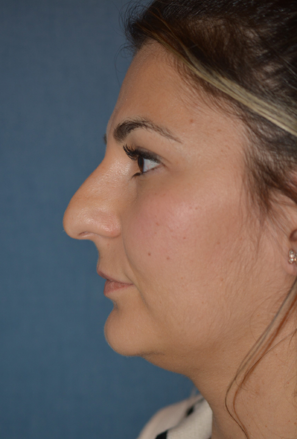 Nose Reshaping Before