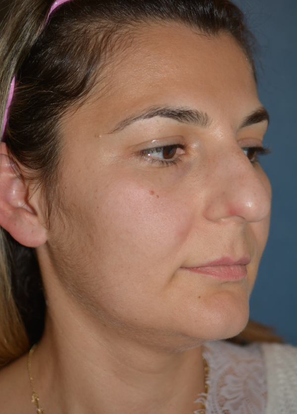 Nose Reshaping Before