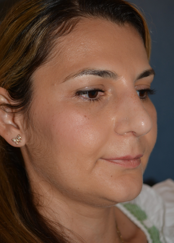 Nose Reshaping After