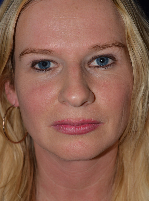 Nose Reshaping Before