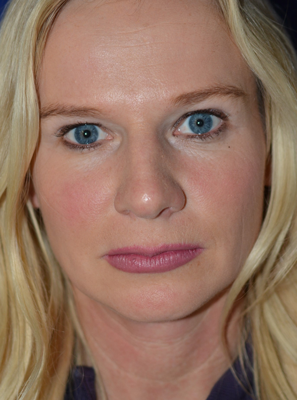 Nose Reshaping After