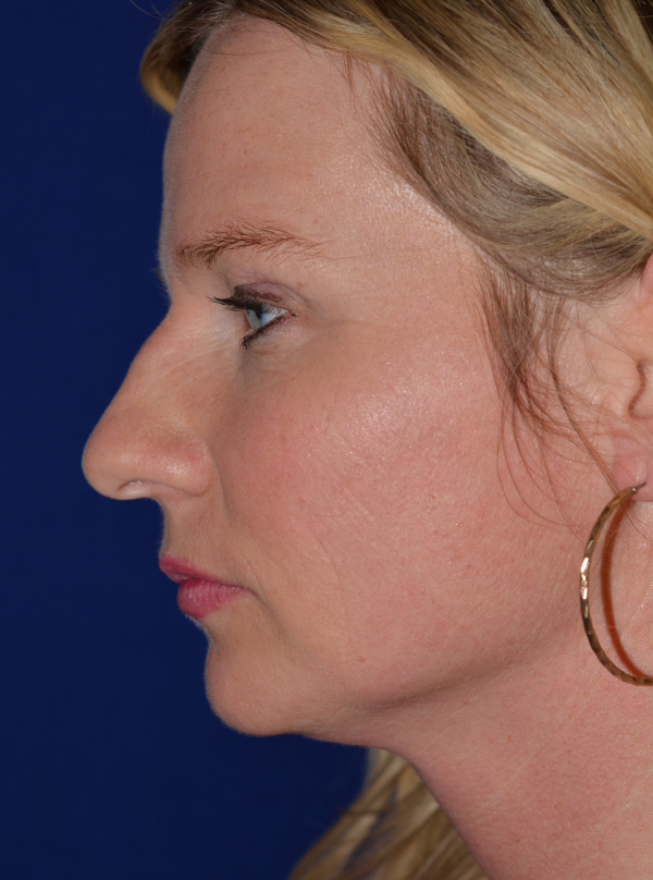 Nose Reshaping Before