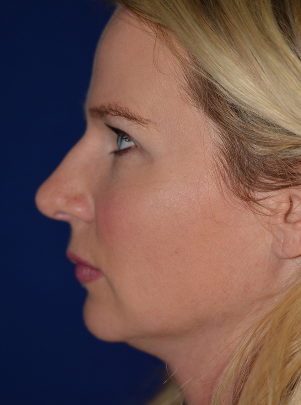Nose Reshaping After