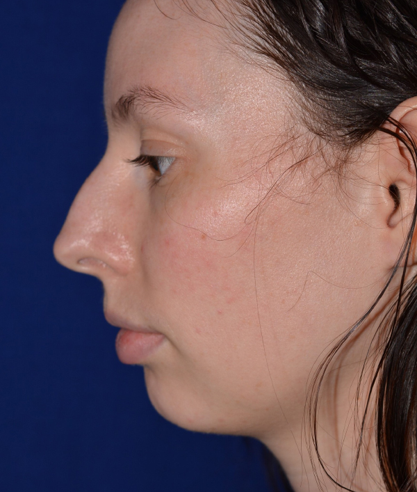 Nose Reshaping Before
