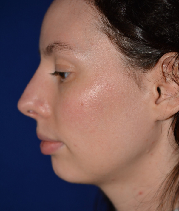 Nose Reshaping After