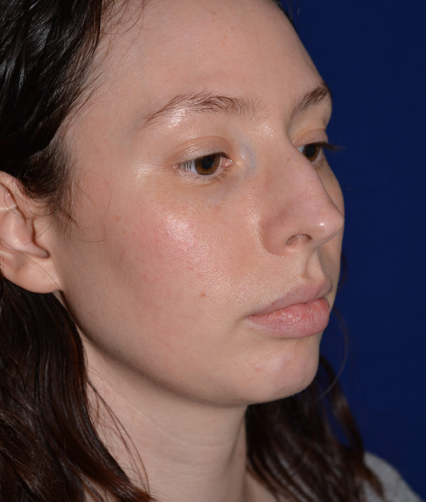 Nose Reshaping Before