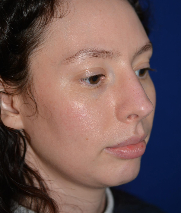 Nose Reshaping After