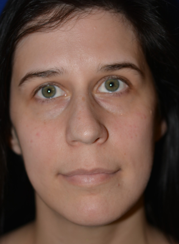 Nose Reshaping Before
