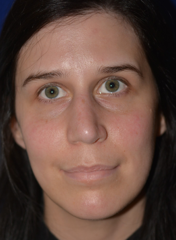 Nose Reshaping After