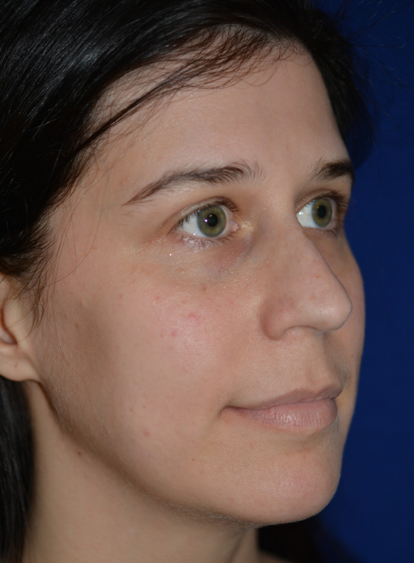 Nose Reshaping Before