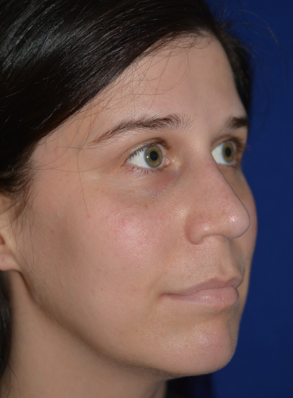 Nose Reshaping After