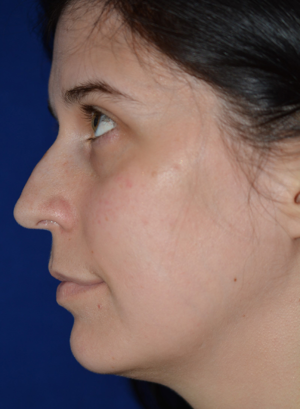 Nose Reshaping Before