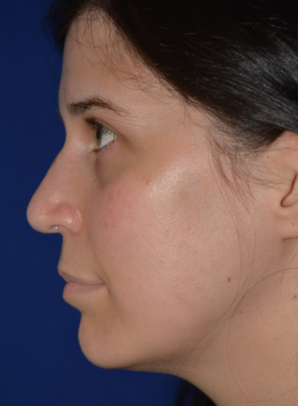 Nose Reshaping After