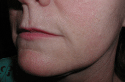 Restylane® After