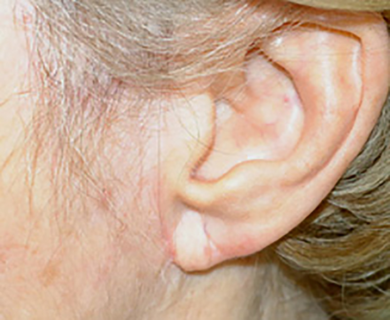Restylane® Before