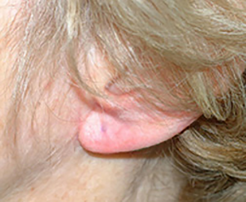Restylane® After