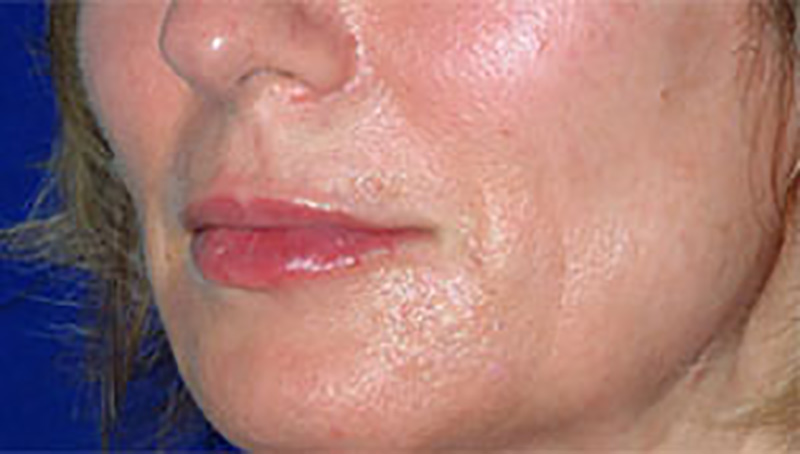 Lip Enhancement with Restylane®