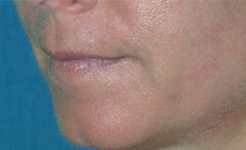 Lip Augmentation with Restylane®
