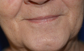 Lip Augmentation with Restylane®
