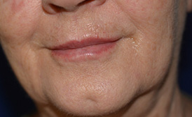 Lip Enhancement with Restylane®