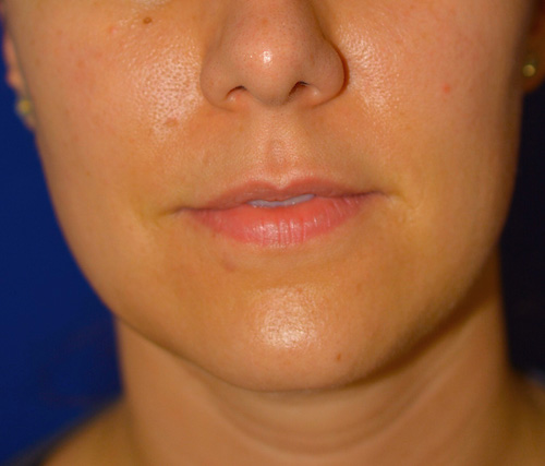 Lip Augmentation with Restylane®