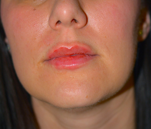 Lip Enhancement with Restylane®