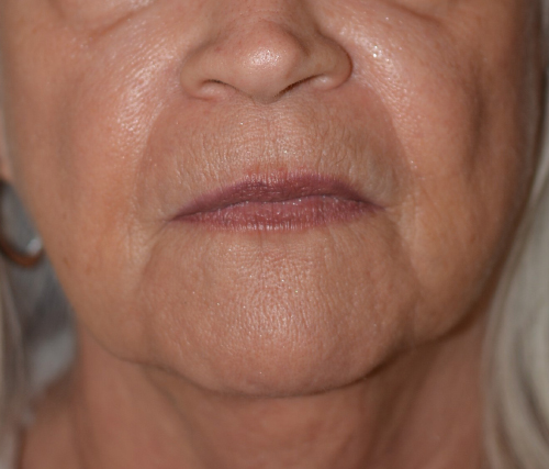 Before Restylane®