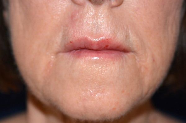 After Restylane®