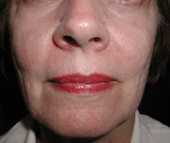 Skin Rejuvenation After