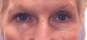 Skin Rejuvenation Before