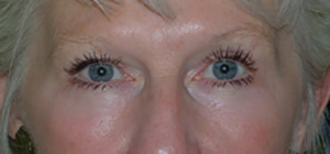 Skin Rejuvenation After