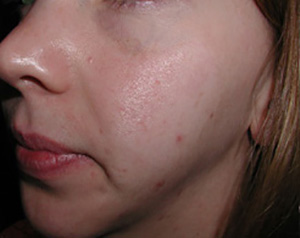Skin Rejuvenation Before
