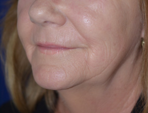 Skin Rejuvenation After