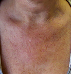 Skin Rejuvenation Before