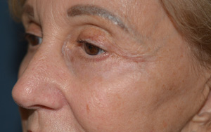 Skin Rejuvenation After