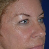 Skin Rejuvenation Before